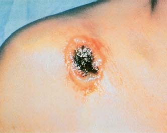 Over the course of a few days, cutaneous anthrax develops into a sore with a coal-black center. Custom Medical Stock Photo, Inc.