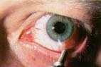Antibiotic eyedrops or ointments are applied to the eye to treat bacterial conjunctivitis. Custom Medical Stock Photo, Inc.