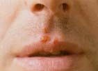 Herpes simplex virus type 1 causes small, clear blisters to appear around the mouth and nose. Also called cold sores, fever blisters, or sun blisters, they typically unite to form a larger sore. Custom Medical Stock Photo, Inc.