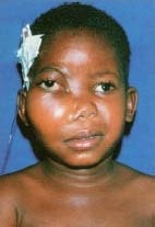 A child with Burkitt's lymphoma, a type of tumor first discovered in Africa. The African form of Burkitt's lymphoma is strongly associated with early childhood infection by the Epstein-Barr virus. Custom Medical Stock Photo, Inc.