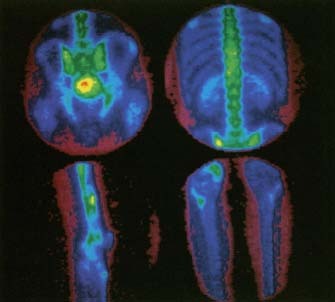 Special bone scans are used to diagnose osteomyelitis. The affected areas of bone "light up" on these scans. Custom Medical Stock Photo, Inc.