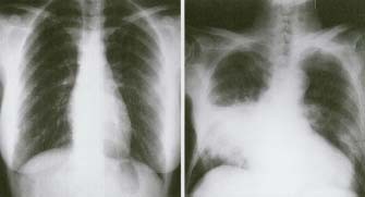These chest X rays compare clear, healthy lungs with the cloudy, inflamed lung tissue of pneumonia. Custom Medical Stock Photo, Inc.