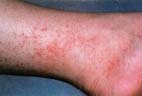 The rash associated with Rocky Mountain spotted fever usually starts as small pink spots, which, over time, become raised. ©Ken E Greer