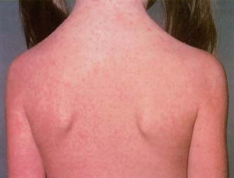 This child has the characteristic rash of rubella. The rubella vaccine has greatly decreased the number of cases in the United States since it was put into use in 1969. Although rubella is generally not serious in otherwise healthy people, in pregnant women it is associated with birth defects and miscarriage. Custom Medical Stock Photo, Inc.