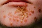 The staph infection called impetigo most often involves the face. Impetigo is more common among young children. In young adults, it may be a complication of other skin problems. Custom Medical Stock Photo, Inc.