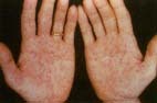An example of secondary syphilis. If syphilis is not treated in its first phase, it can progress to its second stage a month or two later in which a rash may appear on the palms of the hands and the soles of the feet. Custom Medical Stock Photo, Inc.
