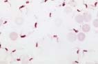 A microscopic view of blood infected with the protozoa that cause, trypanosomiasis. These symptoms cause a disease known as sleeping sickness in Africa and Chagas disease in Latin America. Custom Medical Stock Photo, Inc.