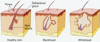 Healthy skin (left) has pores, hair follicles, and sebaceous glands that make an oily substance called "sebum." Sebum helps keep skin and hair healthy by carrying away dead skin cells that have been shed by the follicle linings. If the cells shed too fast and stick together, they may form a plug at the surface of the skin. If the opening to the surface stays partly open, the top of the plug may darken, causing a blackhead (center). If the opening to the surface closes, the follicle may fill up and its wall may start to bulge, causing a whitehead (right). If the follicle wall bursts, the oil, cells, and bacteria spill into the skin. The result is redness, swelling, and pus.