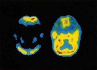 PET scans (positron emission tomography) comparing the brain of a person with Alzheimer's disease (left) with a healthy brain (right). NIH/Science Source, Photo Researchers, Inc.
