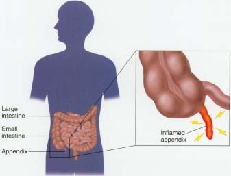 Appendicitis occurs when the appendix, located at the large intestine, becomes infected with bacteria and inflamed.