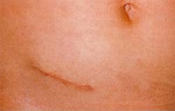 This is an appendectomy scar on the lower right side of the abdomen one week after surgery. New surgical techniques can make scars less noticeable. Dr. P. Marazzi/Science Photo Library. Photo Researchers, Inc.