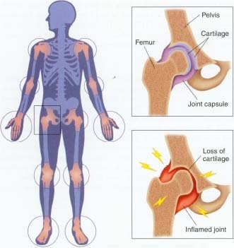 Arthritis may affect many different parts of the body, including shoulders, elbows, hands, hips, and knees (left). In healthy joints (top right), a flexible cushion of cartilage allows bones to slide past each other smoothly. But in arthritis (bottom right), cartilage loss forces the bones to touch without their usual cushioning, which creates pain and inflammation.