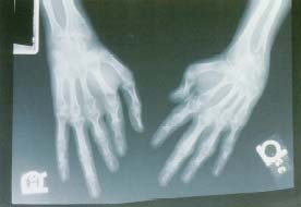 Doctors use x-rays to diagnose rheumatoid arthritis, which often affects the hands. People with rheumatoid arthritis may feel stiffness when they wake up in the morning, and their joints may feel warm to the touch. © 1998 Michael English, M.D., Custom Medical Stock Photo.