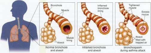 Asthma attack: 1. Location of bronchial tubes/alveoli. 2. Normal. 3. Inflamed. 4. Bronchospasm with trapped air.