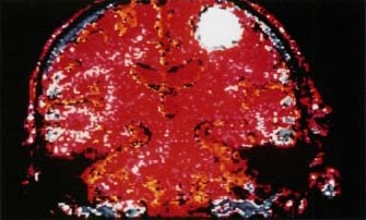 Doctors often use MRIs (magnetic resonance images) as part of the diagnostic process. Here a brain tumor shows up as a roundish spot that differs from the healthy brain tissue nearby. Visuals Unlimited.