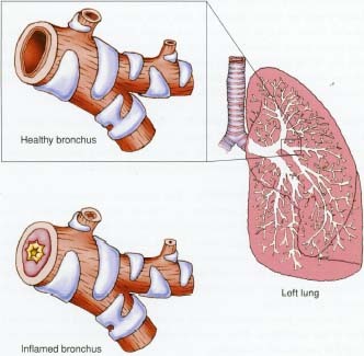 Close-up view of the anatomy of the left lung and of one of its bronchial tubes, which is called a bronchus. Healthy bronchi bring air in and out of the lungs, but people with irritated and inflamed bronchi have mucus clogging up the inside of the tubes. The inflammation interferes with breathing, and it causes coughing that often brings up the mucus.