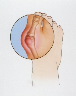 A bunion is formed when the first metatarsal bone (along the inner side of the foot) pushes out at the base of the big toe, and the big toe is displaced toward the smaller toes. The bump that characterizes a bunion is caused by joint inflammation and swelling. © 1998 T. Buck/Custom Medical Stock Photo.