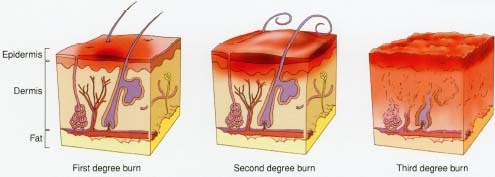 First degree burns affect only the top layer of skin (the epidermis). Second degree burns affect the epidermis and the dermis. Third degree burns are the most serious. They affect deeper layers of tissue, including nerves, sweat glands, fat, and hair follicles.