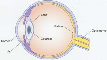 Cataracts develop slowly, causing the eye's clear lens to become cloudy. Cataracts can be removed surgically.