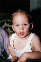 A boy with chickenpox. © John D. Cunningham, Visuals Unlimited