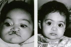 As a baby, Shantell had surgery to repair her complete cleft palate and cleft lip. Here she is before (left) and after (right). Courtesy of Janet Salomonson, MD., Santa Monica, CA/Cleft Palate Foundation.