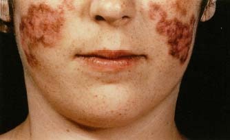 Systemic lupus erythematosus (SLE) may cause a distinctive butterfly-shaped rash on the face. 1993 Custom Medical Stock Photo.