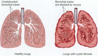 Cystic fibrosis is a chronic disease in which the glands produce excessively sticky mucus that can clog the bronchial tubes in the lungs, making it difficult to breathe.
