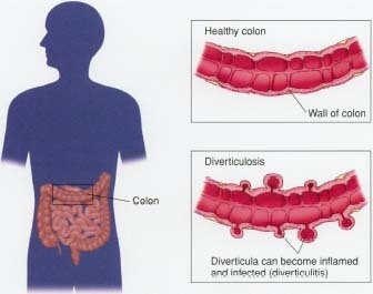 Diverticula are small pouches bulging from the wall of the intestines.