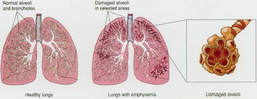 Healthy lungs (left). Lungs with emphysema showing damaged alveoli (center). Close-up of damaged alveoli.