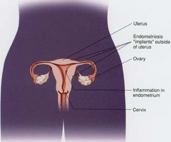 The endometrium is the lining of the uterus. In women with endometriosis, fragments of endometrial tissue become attached to other organs outside the uterus. The symptoms of endometriosis may include heavy bleeding, abdominal pain, lower back pain, and tenderness and pain in the pelvic area.