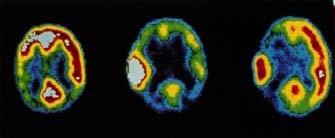 Epileptic seizures have different phases, as shown on these positron emission (PET) scans. The stage shown in the middle is the most severe. NCI/Photo Researchers, Inc.