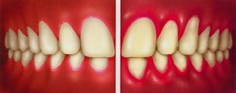 Gum disease causes the gums to become red, swollen, and inflamed. Compare the healthy gums on the left to the diseased gums on the right.