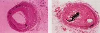 A coronary artery showing (left) moderate atherosclerosis and (right) severe atherosclerosis. © W. Ober, Visuals Unlimited