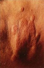 Close-up of hives. © 1994 Caliendo, Custom Medical Stock Photo