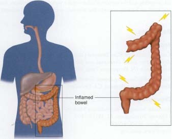 When inflammation occurs in the large intestine (colon) or in the lower part of the small intestine (ileum), it causes pain and swelling and may lead to diarrhea. weight loss, fatigue, and fever.