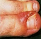 Ingrown toenails that have become infected may be treated with antibiotics. People with diabetes or circulatory system problems should receive regular foot care from a medical doctor or podiatrist. Dr. P Marazzi, Science Photo Library/Photo Researchers, Inc.