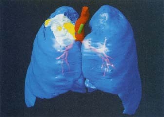 This color-enhanced CT scan shows what lung cancer looks like inside the body. Healthy lung tissue is shown in blue, and the major air passages are in red. The cancerous lung tumor is yellow, and the green rod is the tube (endoscope) that the doctor uses to view the tumor and to plan surgery to remove it. Volker SteeSiem, Science Photo LibraT/Photo Reseanhers, Inc.