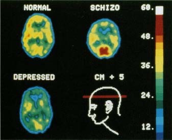 Doctors and researchers use computer-generated positron emission tomography (PET) scans to study how the brain functions. These PET scans compare brain activity in a healthy person (top left), a person with schizophrenia (top right), and a person with depression (lower left). The red line through the diagram at the lower right shows the area of the brain that is depicted in the scans. NIH/Science Source, Photo Researchers, Inc.