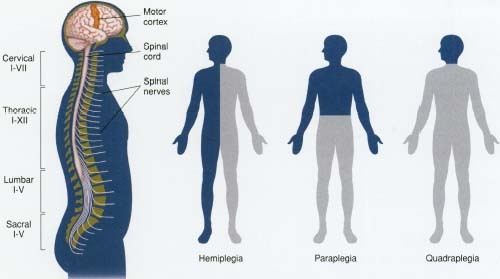 Left to right: Spinal cord showing regions (cervical, thoracic, lumbar, etc.) and nerves; hemiplegia; paraplegia; and quadriplegia.