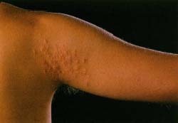 This young man has a skin rash on his upper arm caused by hookworm larvae. St. Bartholomews Hospital/Science Photo Library/Photo Researchers, Inc.