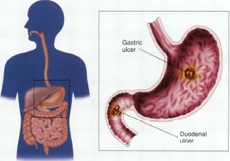 Peptic ulcers may occur in the stomach (gastric ulcers) or in the first part of the small intestine (duodenal ulcers). Nearly all peptic ulcers are the result of infection with H. pylori bacteria.