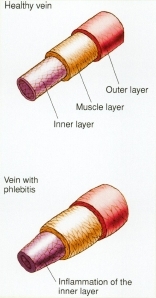 Healthy vein versus vein with phlebitis.
