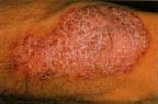 Large red and white scaly rash on the arm of a 67-year-old man. Dr. PMarazzil Science Photo Library/Photo Reseachers, Inc.