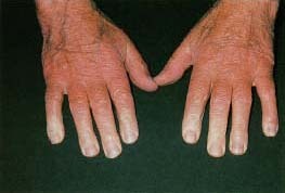 An elderly man has whitened fingers from Raynaud's disease. His fingertips are white because the arteries are constricted, which cuts off blood supply and causes numbness and tingling. Dr. P Marazzi/Science Photo Library/Custom Medical Stock Photo