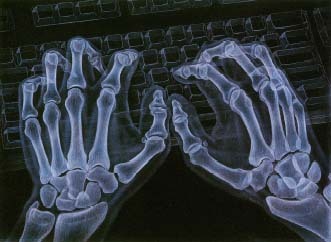 Office workers who overuse computer keyboards are at risk for repetitive strain injury. © 1994 T Buck/Custom Medical Stock Photo.
