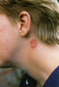 The red circular rash behind the ear is an example of ringworm of the body, or tinea corporis. John Hadfield, Science Photo Library/Photo Researchers, Inc.