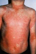 Scarlet fever body rash. © Biophoto Associates/Photo Researchers, Inc.