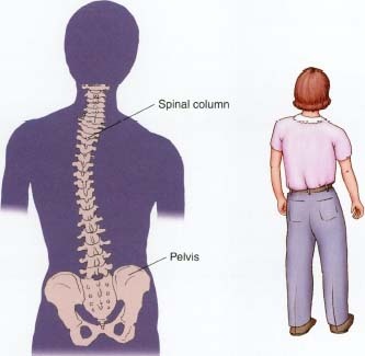 Spinal column and pelvis in an adolescent girl with scoliosis.