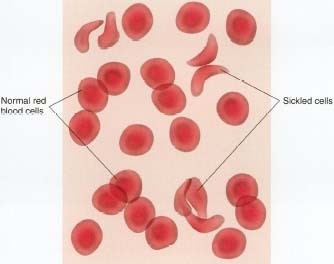 The shape of sickled red blood cells compared to normal red blood cells.