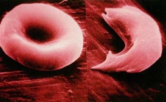 One normal and one sickled red blood cell side by side under the electron microscope, photographed at 18,000 times actual size. © Stanley Flegler, Visuals Unlimited.